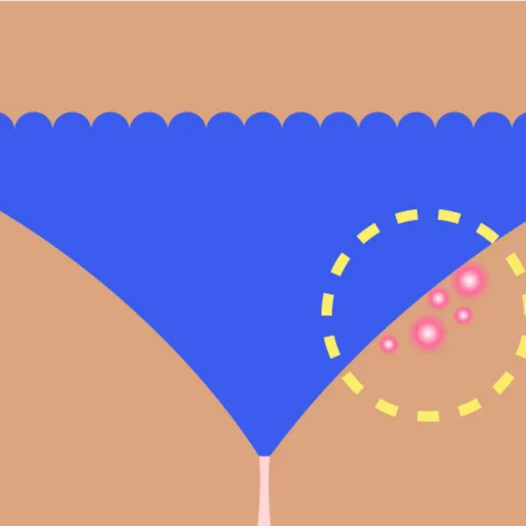 Ingrown Hairs and Razor Bumps: What's the Difference?