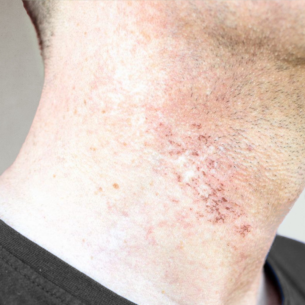 How to fix razor burn top