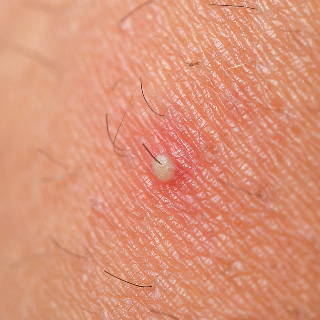 The Complete Guide To Ingrown Hairs Lane44 Lane 44 the-complete-guide-to-ingrown-hairs-lane44-lane-44