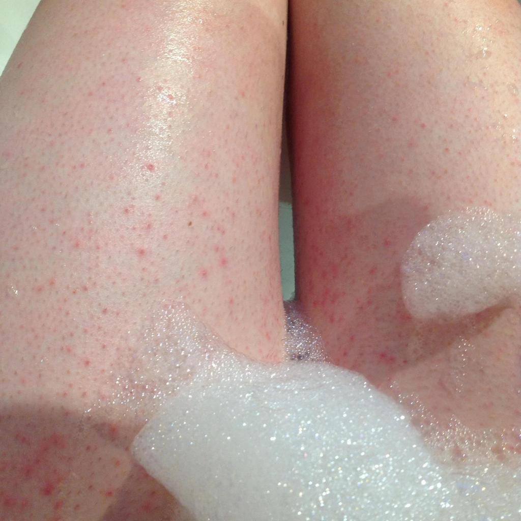 What are Razor Bumps Shaving Rash Advice Lane44 Lane 44